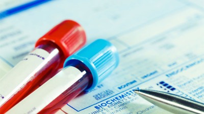 Naučnici razvili prvi ‘precizan krvni test’ za otkrivanje sindroma hroničnog umora
