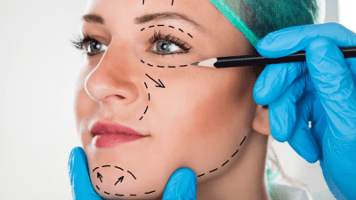 Facelift u 30-ima: Zašto sve više mladih žena bira invazivnu estetsku operaciju