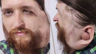 Udruženje Pomozi.ba pokrenulo apel za Jasenka Ramića (29) iz Tuzle kojem tumor predstavlja direktnu prijetnju životu