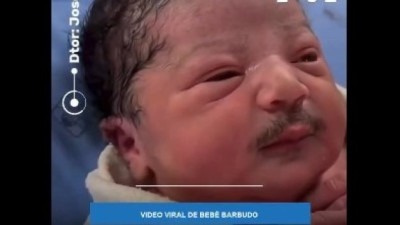 Video: Beba rođena sa brkovima i bradom, stručnjaci objasnili o čemu je riječ